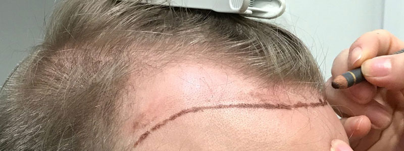 Hair Transplant Before After Images